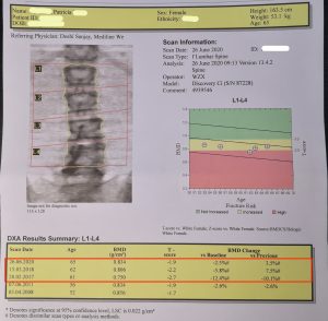 osteoporosis, bone scan, bone mass density, osteopenia