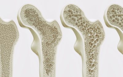 Strength Training for Osteoporosis – How Stressing Your Bones Actually Makes Them Stronger